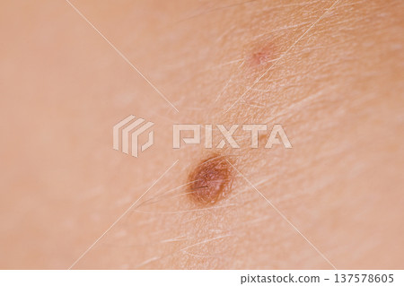 Closeup brown mole on caucasian woman skin. 137578605