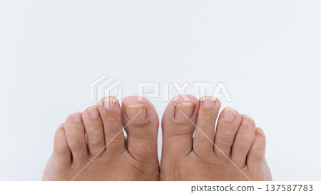 Close-up view of human feet showing ingrown toenails on big toes, highlighting foot health issues and personal care in a clean environment Close-up view of human feet showing ingrown toenails on big toes, highlighting foot health issues and personal care in a clean environment 137587783