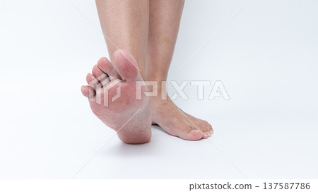 Close-up view of a bare foot showing corns and calluses, highlighting foot health issues and skin texture in a clean, minimalistic setting 137587786