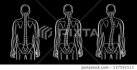 Scoliosis spine deformity 137591513