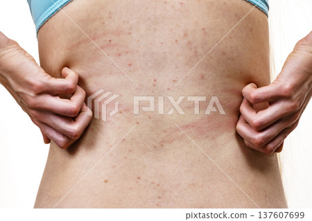 Woman scratching her itchy back with allergy rash Woman scratching her itchy back with allergy rash 137607699