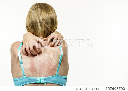 Woman scratching her itchy back with allergy rash 137607700