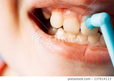 Close up child brushing teeth with a single tuft toothbrush, dental hygiene and oral care 137614113