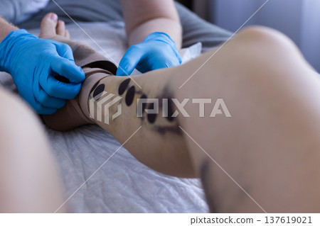 Doctor takes compressive stockings off from patient leg to check wounds some days after invasive surgery. Doctor takes compressive stockings off from patient leg to check wounds some days after invasive surgery. 137619021