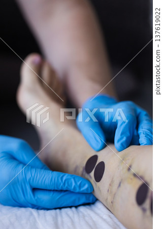 Doctor checking wounds some days after innovative method of varicose veins surgery, sclerotherapy procedure. 137619022
