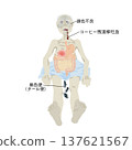 上消化道出血症狀圖示：嘔血、黑便、蒼白，醫學教育圖表 137621567