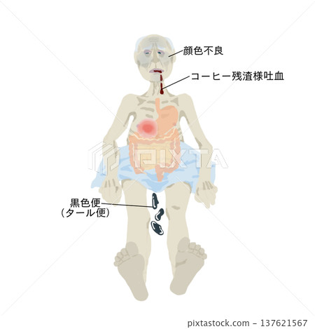 Illustration of symptoms of upper gastrointestinal bleeding: vomiting blood, black stools, pale complexion, medical education chart 137621567