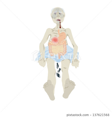 Illustration of symptoms of upper gastrointestinal bleeding: vomiting blood, black stools, pale complexion, medical education chart 137621568