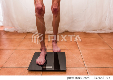 Woman with anorexia standing on bathroom scale Woman with anorexia standing on bathroom scale 137631973