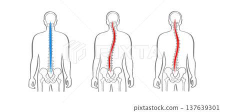 Scoliosis spine deformity 137639301