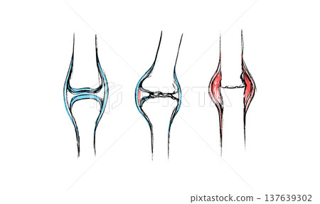 Arthritis Sketch Poster Arthritis Sketch Poster 137639302