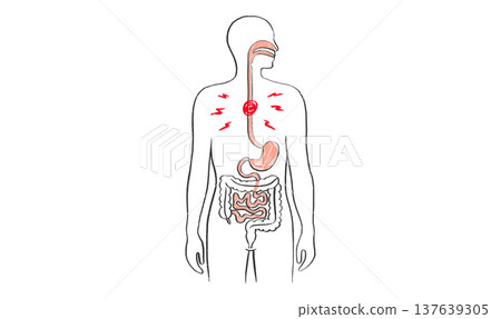 Esophagus pain diagram Esophagus pain diagram 137639305
