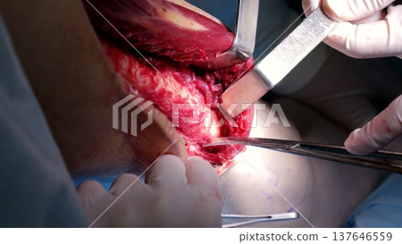 Surgical team performing intricate knee operation, using advanced medical instruments to resolve complex orthopedic condition with precision and expertise 137646559