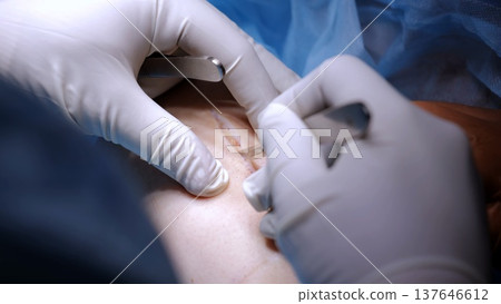 Surgical team performing delicate operation, sterile gloved hands collaborating with utmost concentration during complex medical intervention 137646612