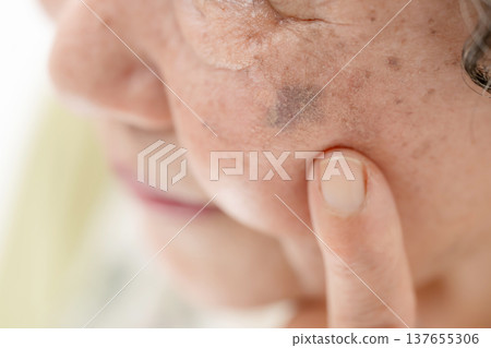 老年女性，老年斑 137655306