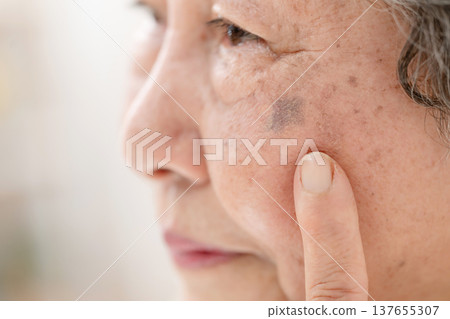 老年女性，老年斑 137655307