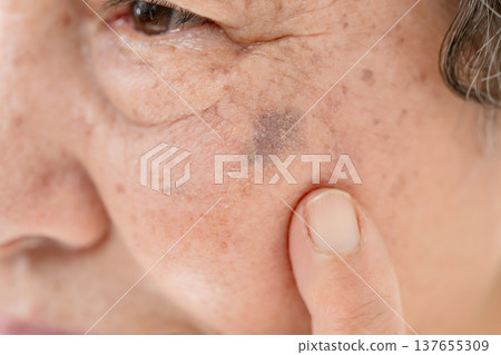 Senior women, age spots Senior women, age spots 137655309