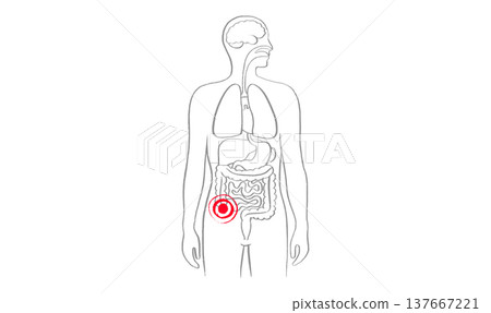 Inflamed appendix scetch 137667221