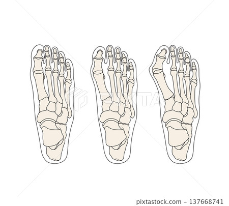 Human foot skeleton anatomy showing hallux valgus bunion progression, medical orthopedic diagram set Human foot skeleton anatomy showing hallux valgus bunion progression, medical orthopedic diagram set 137668741