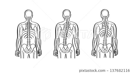 Scoliosis spine deformity 137682116