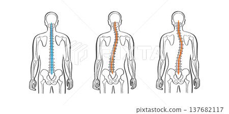 Scoliosis spine deformity 137682117