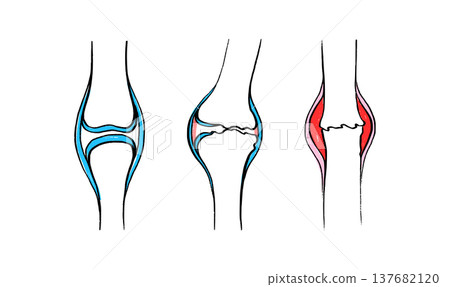 Arthritis Sketch Poster 137682120