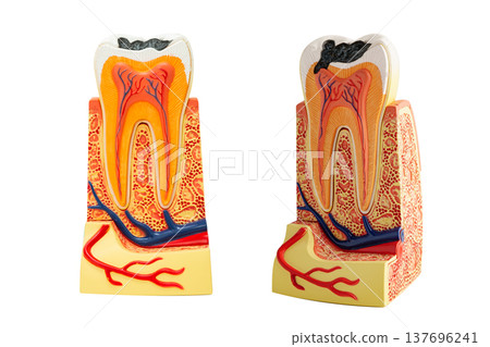 Dental implant, artificial tooth roots into jaw human model isolated on white background. Dental implant, artificial tooth roots into jaw human model isolated on white background. 137696241