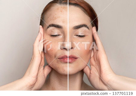 before, after portrait of woman after laser or cream treatment removing freckles or pigment on face with pigmentation, melasma, freckles, age spots photo. Close up photo before, after portrait of woman after laser or cream treatment removing freckles or pigment on face with pigmentation, melasma, freckles, age spots photo. Close up photo 137701119