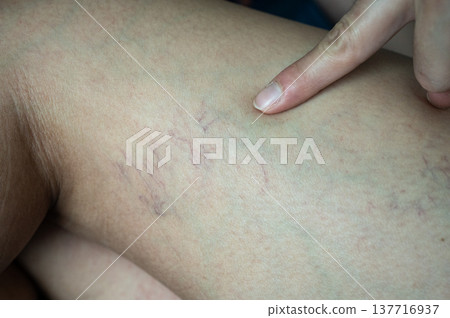 Close up of spider veins occur on woman thigh. Spider veins and Varicose veins are a common condition caused by weak or damaged vein walls and valves. Close up of spider veins occur on woman thigh. Spider veins and Varicose veins are a common condition caused by weak or damaged vein walls and valves. 137716937