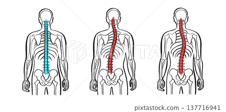 Scoliosis spine deformity 137716941