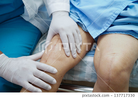 Doctor checking Asian elderly woman patient with scar knee replacement surgery in hospital. 137717330