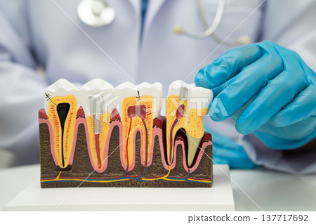 Dentist holding dental implant, artificial tooth roots into jaw, root canal of dental treatment, gum disease, teeth model for dentist. Dentist holding dental implant, artificial tooth roots into jaw, root canal of dental treatment, gum disease, teeth model for dentist. 137717692