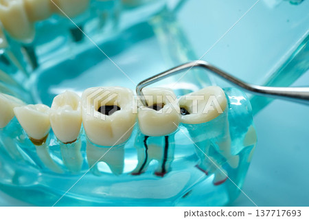 Teeth dental model with tool for dentist use to cleaning care treatment. Teeth dental model with tool for dentist use to cleaning care treatment. 137717693