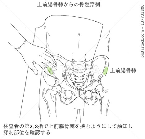 經髂前上棘觸診法行骨髓穿刺術 137733806