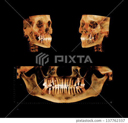 Computed tomography of adult female patient with dental root and implant treatments. Dental x-ray of an adult patient showing teeth, jaws and a dental implant. Modern digital tomography for dentistry Computed tomography of adult female patient with dental root and implant treatments. Dental x-ray of an adult patient showing teeth, jaws and a dental implant. Modern digital tomography for dentistry 137762337