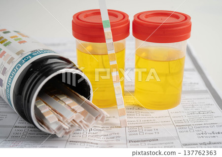 Urinalysis, urine cup with reagent strip pH paper test and comparison chart in laboratory. 137762363