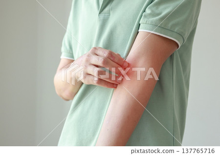 Young asian man itching and scratching on arm from allergic itchy dry skin eczema dermatitis insect bites Young asian man itching and scratching on arm from allergic itchy dry skin eczema dermatitis insect bites 137765716
