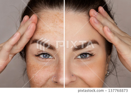 Caucasian woman's face before and after procedure removing pigment from the skin, use cream, laser, LPL, with and without freckles or age spots, cropped, close up Caucasian woman's face before and after procedure removing pigment from the skin, use cream, laser, LPL, with and without freckles or age spots, cropped, close up 137768873