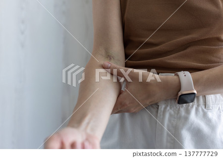 Traces on the hand after taking a vein blood test. Closeup. Traces on the hand after taking a vein blood test. Closeup. 137777729
