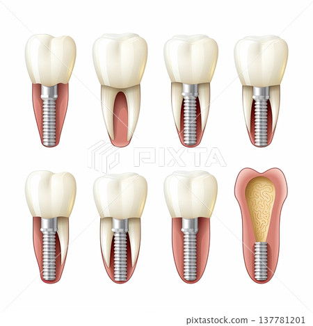 Dental Implant Procedure Stages Illustration of Tooth Replacement and Bone Integration Process 137781201