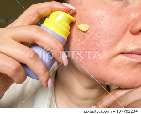 Peeling of facial skin in close-up. Effect after cosmetic procedures. Facial skincare products. High quality photo Peeling of facial skin in close-up. Effect after cosmetic procedures. Facial skincare products. High quality photo 137792234