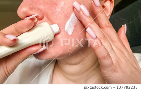 Peeling of facial skin in close-up. Effect after cosmetic procedures. Facial skincare products. High quality photo Peeling of facial skin in close-up. Effect after cosmetic procedures. Facial skincare products. High quality photo 137792235