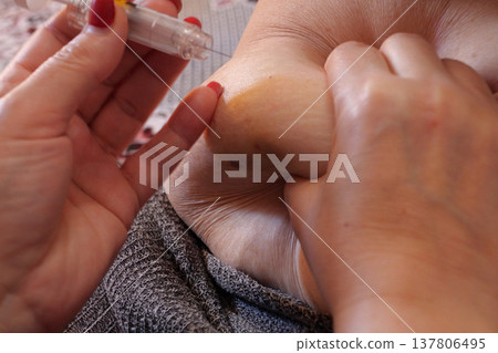 Woman is injecting hormones to belly with syringe. IVF concept close up 137806495