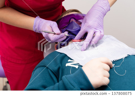 Dentist appointment for a young patient receiving treatment while wearing protective eyewear and a dental bib, capturing the care in a clinic environment during daylight hours 137808075