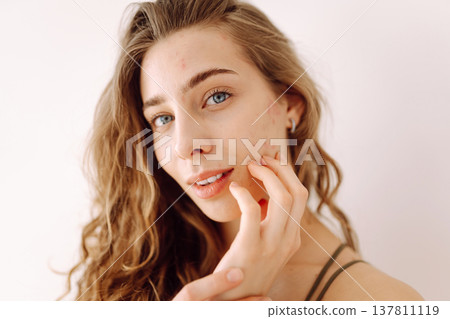 Woman no make up with red spots on her face. Health problem, skin diseases. Medicine and cosmetology Woman no make up with red spots on her face. Health problem, skin diseases. Medicine and cosmetology 137811119