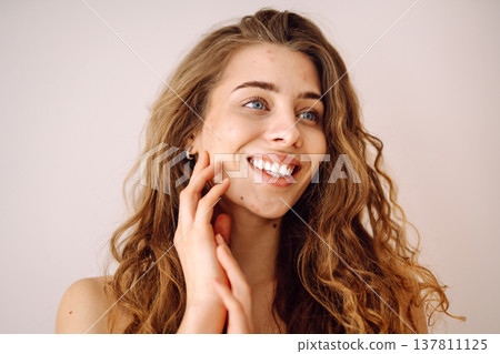 Woman no make up with red spots on her face. Health problem, skin diseases. Medicine and cosmetology 137811125