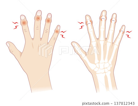 Symptoms of Heberden's nodes, the right hand and its bones Symptoms of Heberden's nodes, the right hand and its bones 137812343