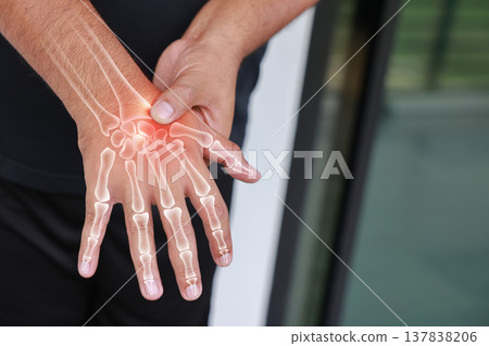 Close up of a human hand showing a visible skeletal bone structure overlay with a red inflamed area on the wrist joint, illustrating carpal tunnel syndrome, arthritis, or a sprain injury. Close up of a human hand showing a visible skeletal bone structure overlay with a red inflamed area on the wrist joint, illustrating carpal tunnel syndrome, arthritis, or a sprain injury. 137838206