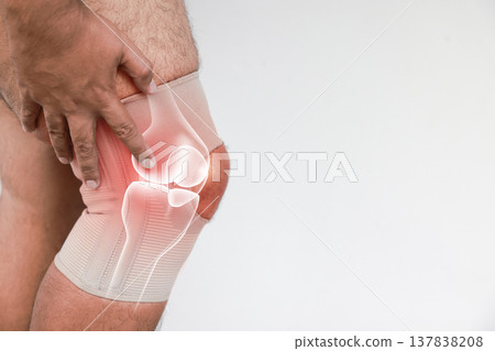 Man suffering from acute knee joint pain, wearing a medical support brace, with a detailed anatomical overlay and red glowing visualization of the inflamed cartilage and ligaments, on white. Man suffering from acute knee joint pain, wearing a medical support brace, with a detailed anatomical overlay and red glowing visualization of the inflamed cartilage and ligaments, on white. 137838208