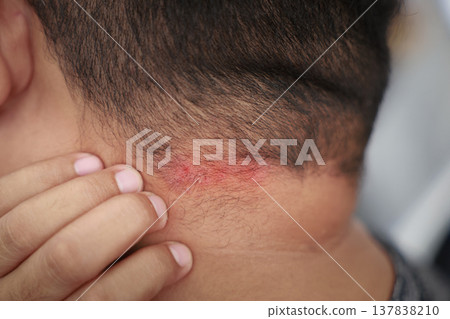 Close up of a man touching an itchy red rash and skin irritation on the back of his neck at the hairline. Concept of dermatology, allergy, eczema, psoriasis, fungal infection or skin disease. 137838210